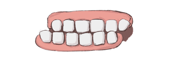 磨牙症
