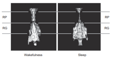 睡眠呼吸暂停