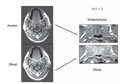 睡眠呼吸暂停